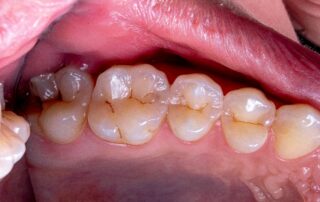 TOOTH PLAQUE BUILD UP