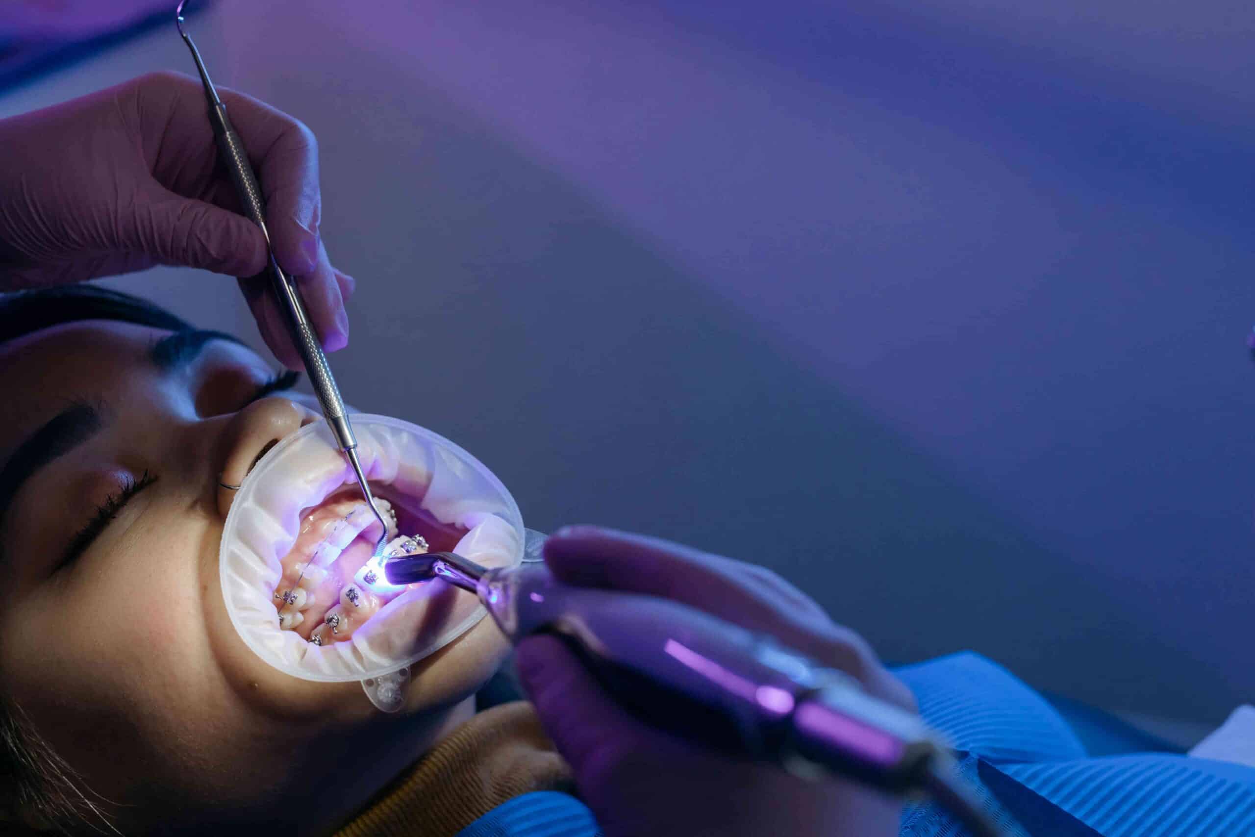 Understanding Fluoride: How It Strengthens Your Teeth 5 patient getting dental work