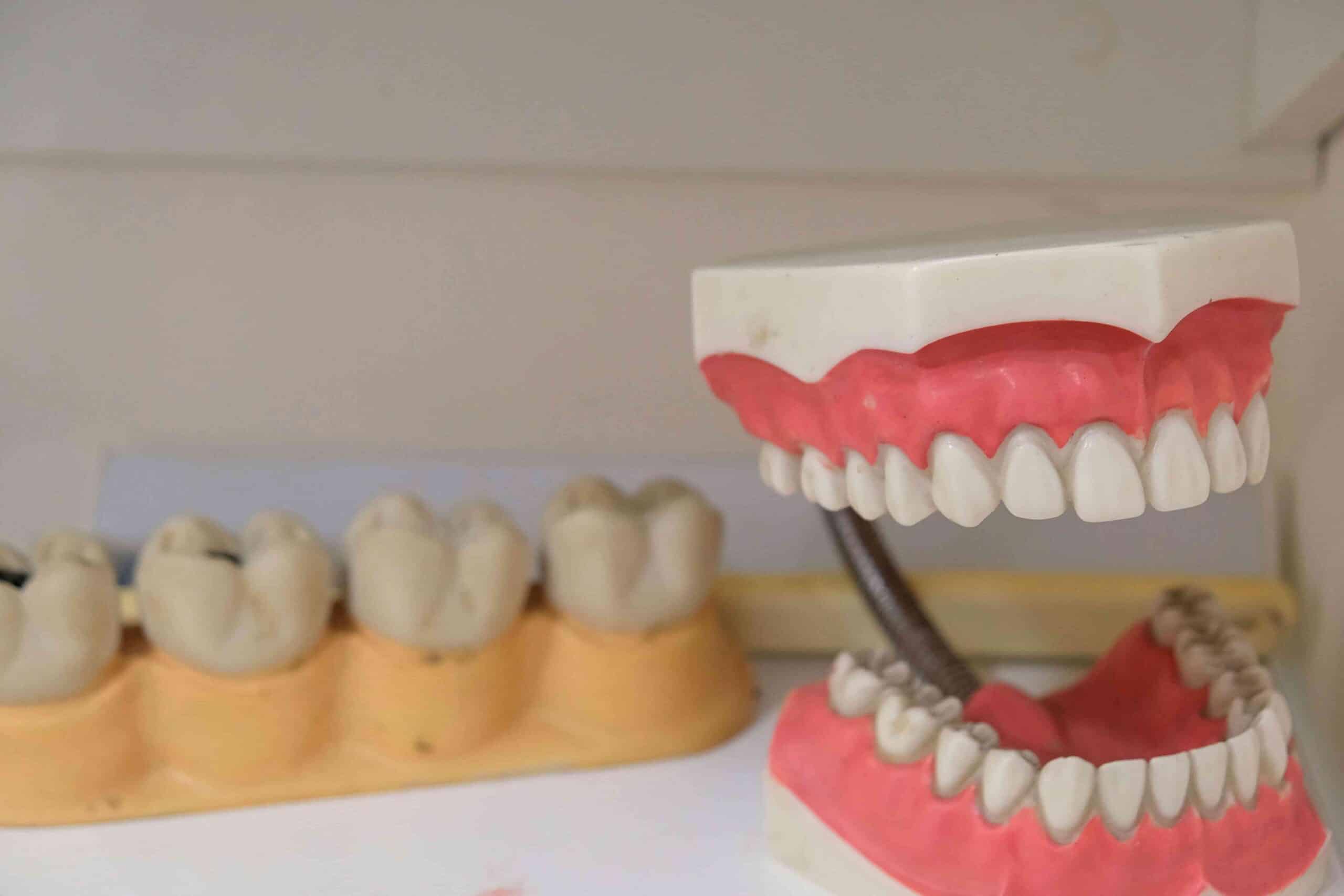 Understanding Fluoride: How It Strengthens Your Teeth 6 model mouth and model teeth