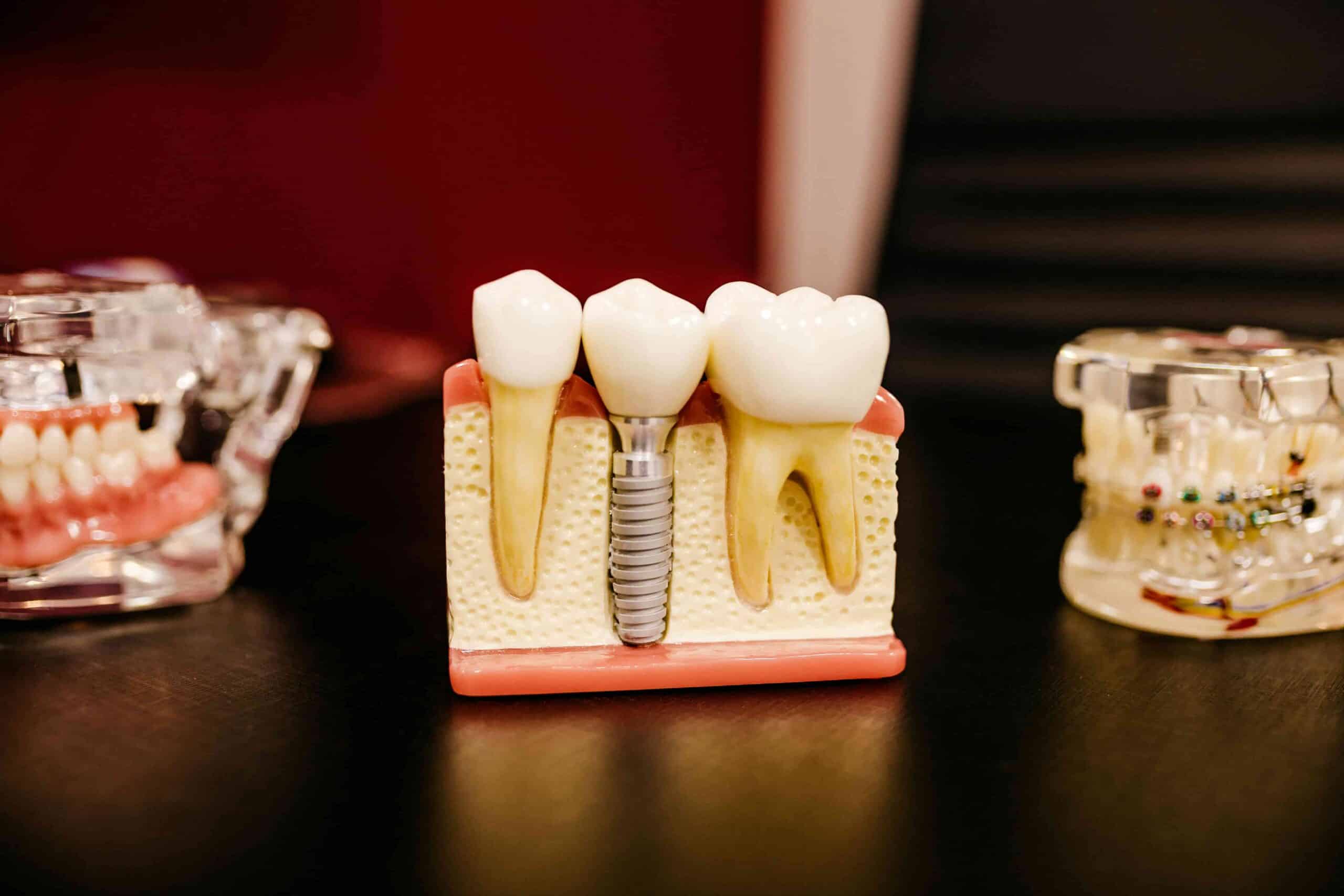 What Are the 3 Types of Dental Implants? A Complete Guide 5 model of dental implant