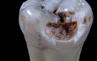 tooth with cavity upclose