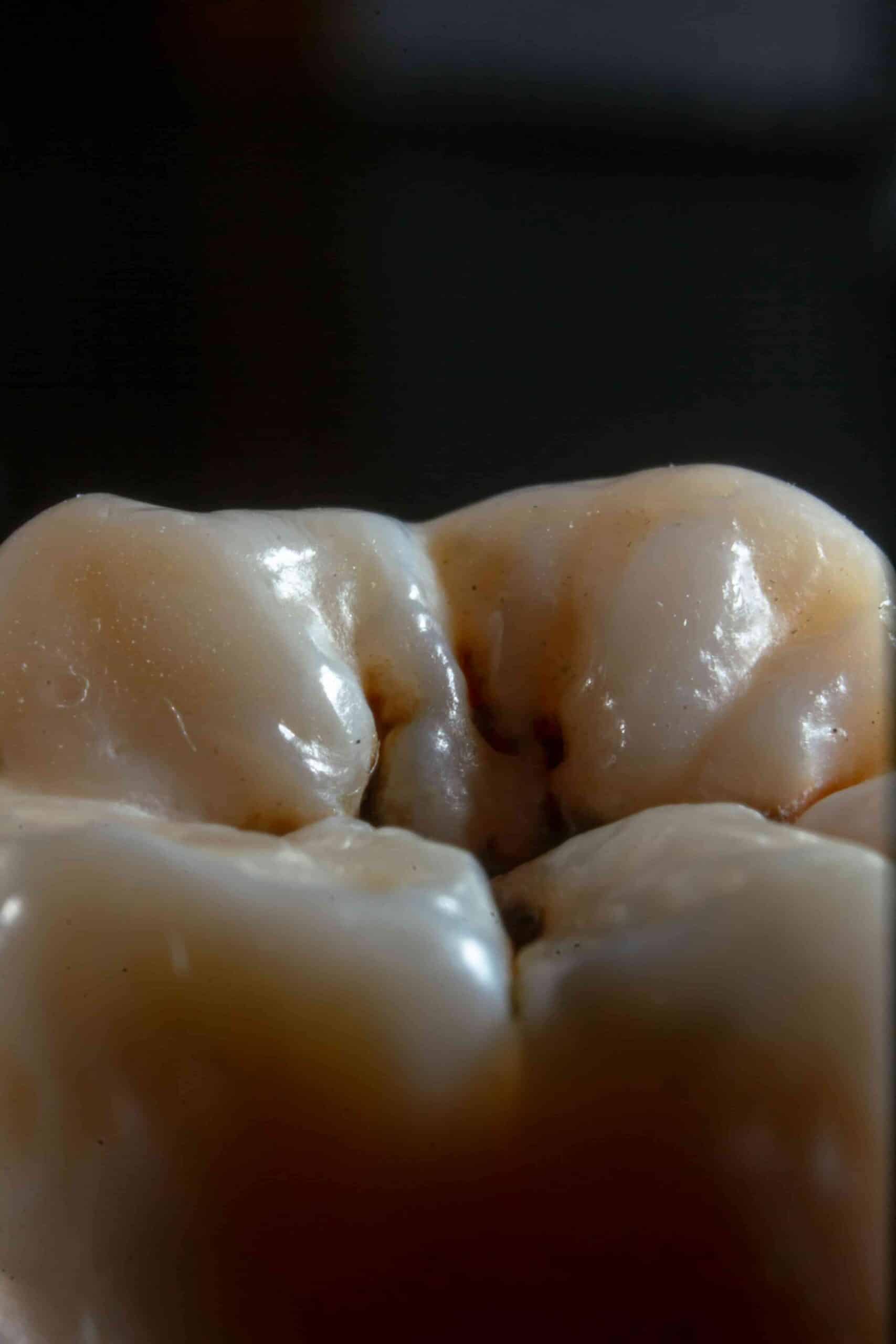 Does Sugar Cause Cavities? What You Need to Know 6 upclose image of cavity