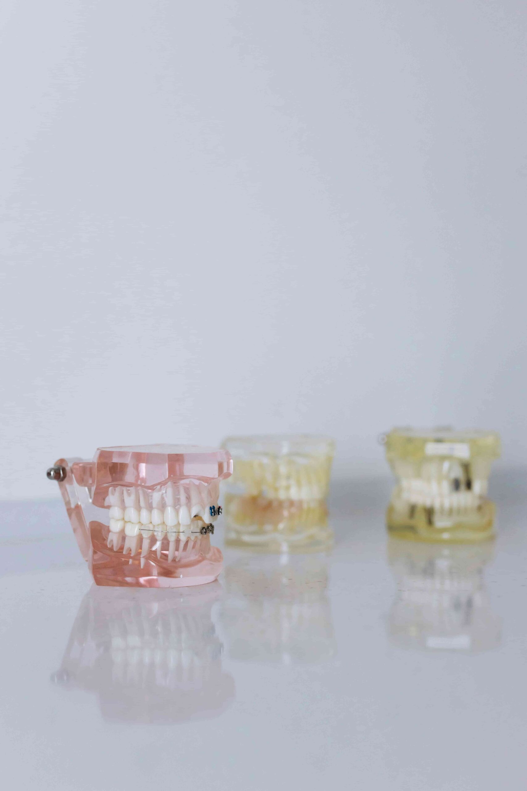 Why Inglewood Families Trust Blue Diamond Dental 5 model dental tteeth with braces