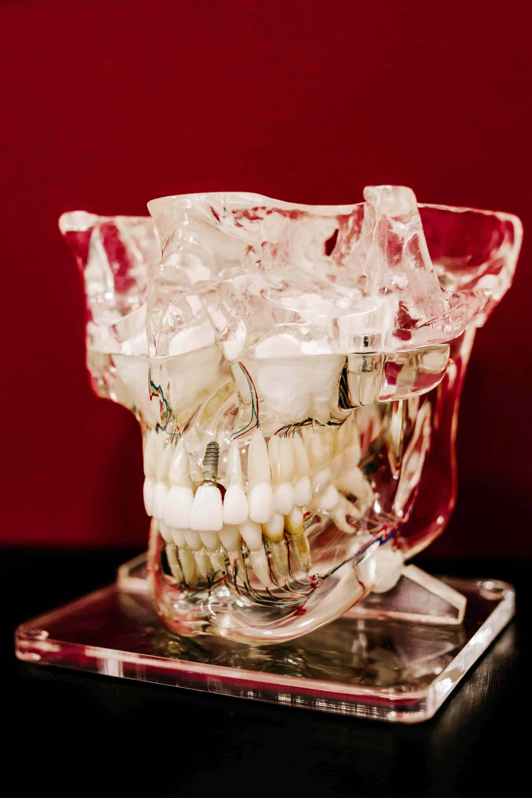 What's the Real Cost of Dental Implants in California? 6 model mouth with dental implant